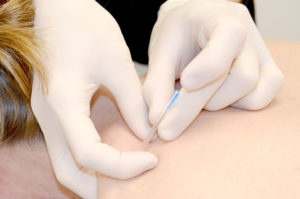 puncion seca kyneos fisioterapia